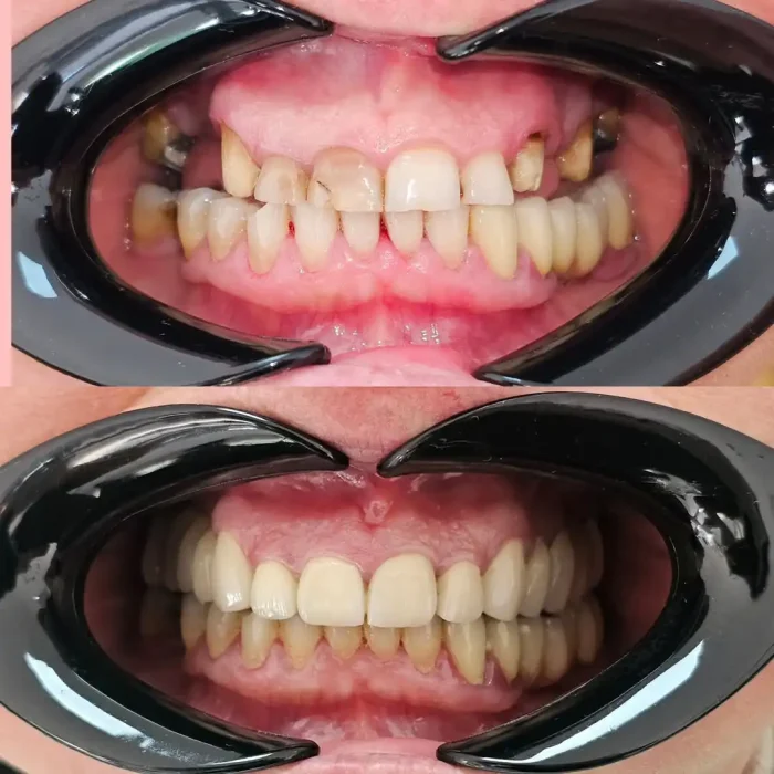 Implant case 056