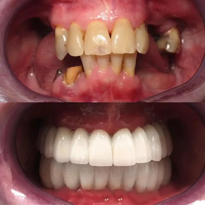 Implant case 080