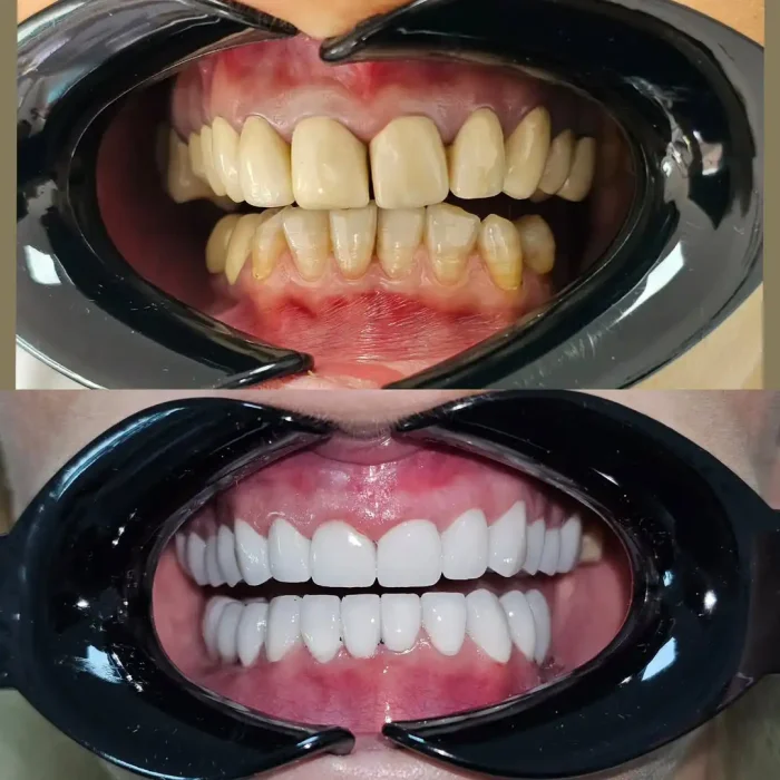Implant case 085
